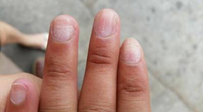 哪些人容易感染灰指甲?