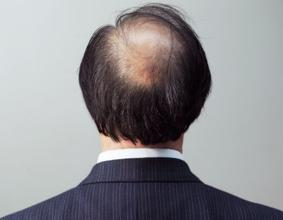 日常生活中脱发的预防措施都有哪些