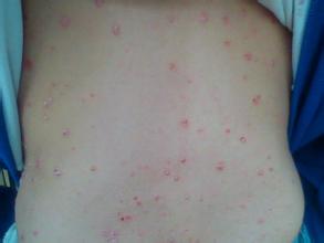 Ƥ������Щ����Σ������֢״?